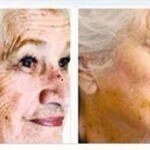 Best Anti Aging Skin Care - Age Spots